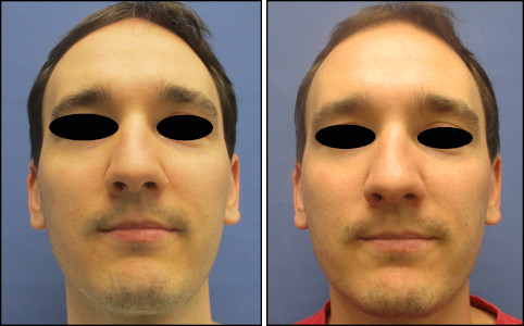 Chicago mole removal shave no scarring